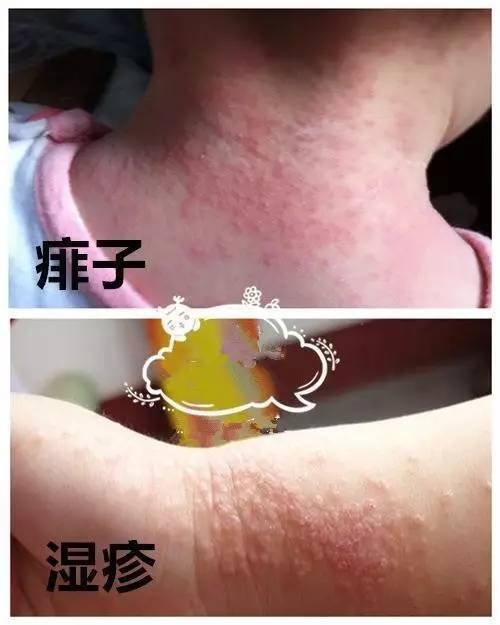 奶疹和湿疹的区别图片