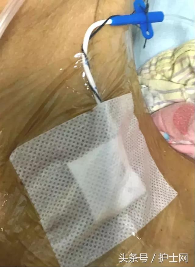 中心静脉导管拔除后,穿刺点如何处理?