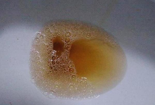 3,小便颜色黄如茶举报   一般来说,我们都知道,尿液是呈淡黄色的,这