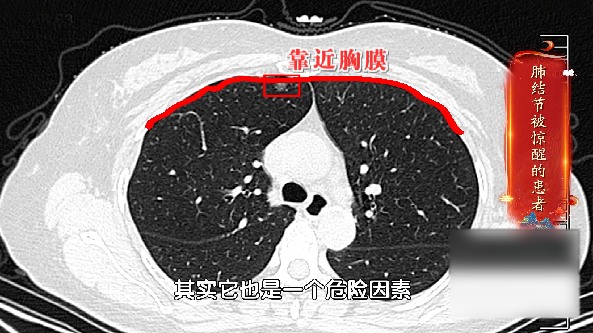 三月份查出结节，不到一年就手术，为什么她的结节要切除？