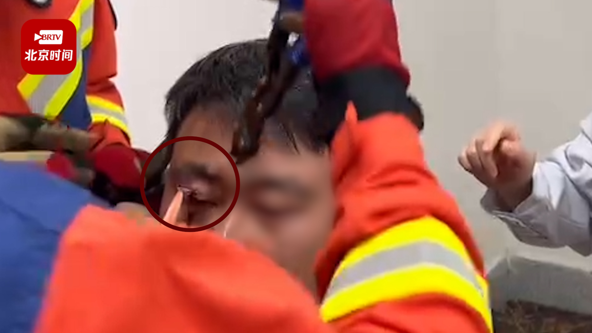 看着都疼！城管巡逻中被飞来鱼钩挂住眼皮