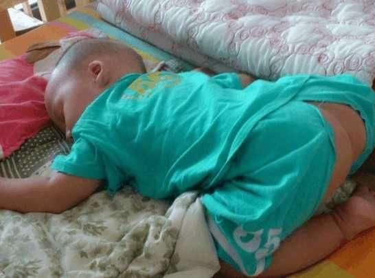 5个月的宝宝尿频伴有肛裂, 医生检查后说的话