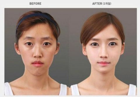 实拍:韩国人整容前后的对比照,丑男变帅男,丑女