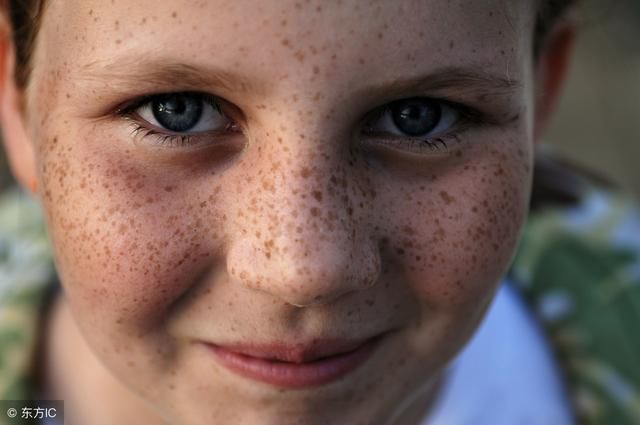 脸上为什么要长老年斑 脸上为什么长老年斑怎样能去掉