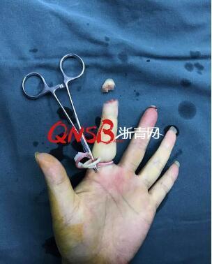 男子被自己养的小狗咬断食指 而且接不回去了