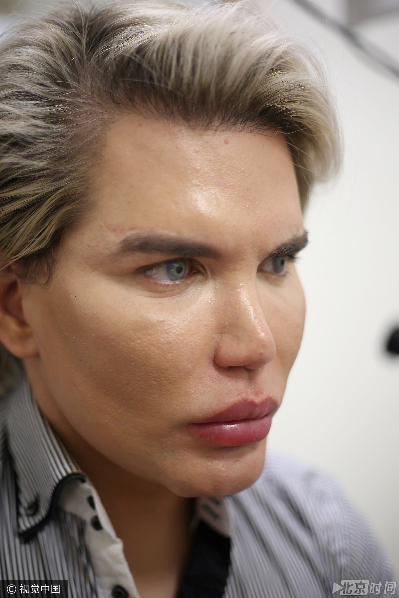 英国整容上瘾男子再出手 不怕死改变眼球颜色