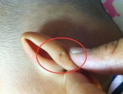耳轮凹陷图片图片