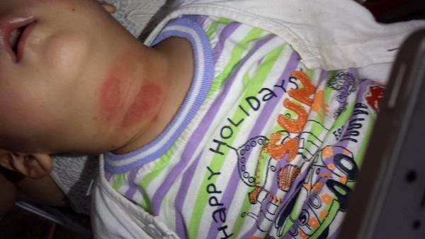 家长注意啦!被这种虫子叮上的几个娃差点毁容!