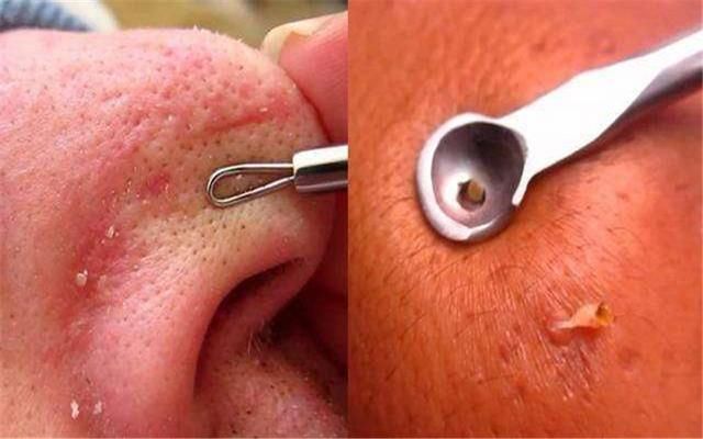 在家怎么快速去黑头 t01479c726e1ab13c91.jpg?size=640x400