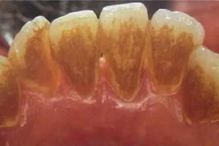 要等到牙结石严重后再洗牙?原来一直都理解错