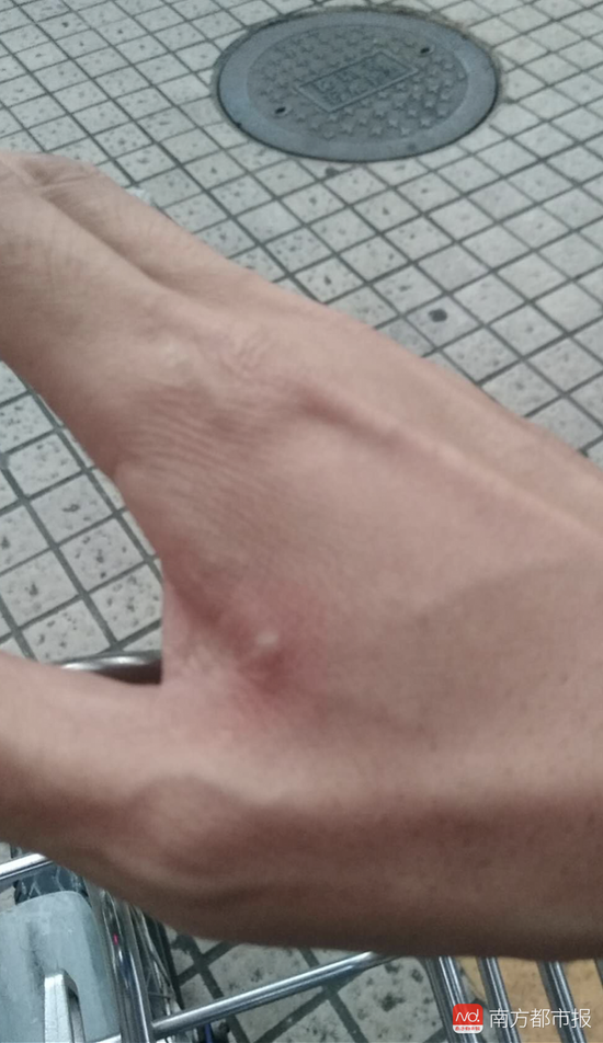 驾校学员被教练香烟烫出水泡 回应:不是故意的