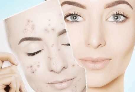 梅梅护肤老师: 什么是激光祛痘, 激光治疗的副作