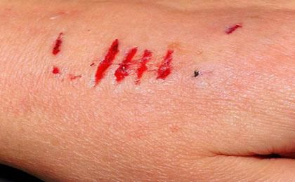 小孩意外险 小孩意外险