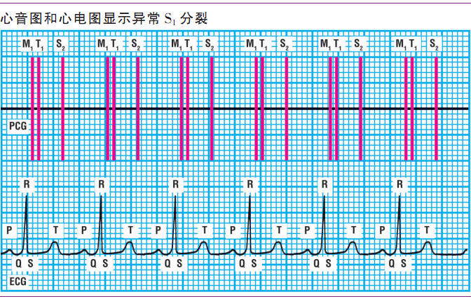 详解第一心音和第二心音,快来磨耳朵吧!|临床基