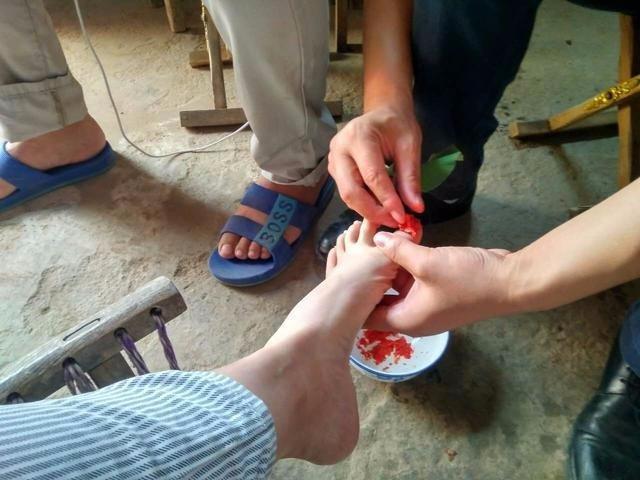 麻叶几瓣花就能治疗灰指甲!