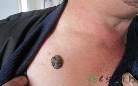 黑色素瘤能治愈吗-北京时间