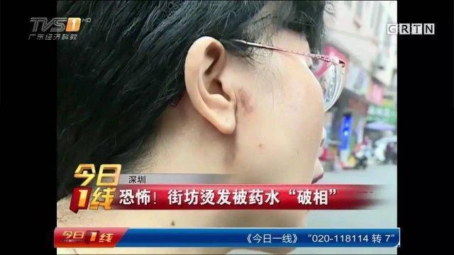 深圳女子街坊烫发直喊痛 竟是药水腐蚀了皮肤