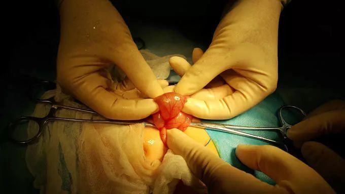 可怕!大妈肚脐眼长个洞 肠子险流出