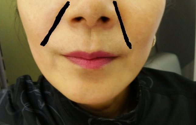 烂香蕉去掉了法令纹?表姐试了三天,法令纹果然