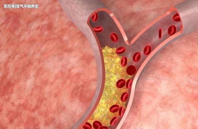 颈部动脉长斑块被堵,常喝1种水,冲扫血管垃圾