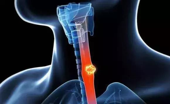 长期吞咽不适警惕食道癌!食道癌的早期症状有