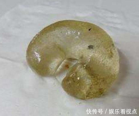 年轻女子身体肿胀,去医院检查,医生检查后发现