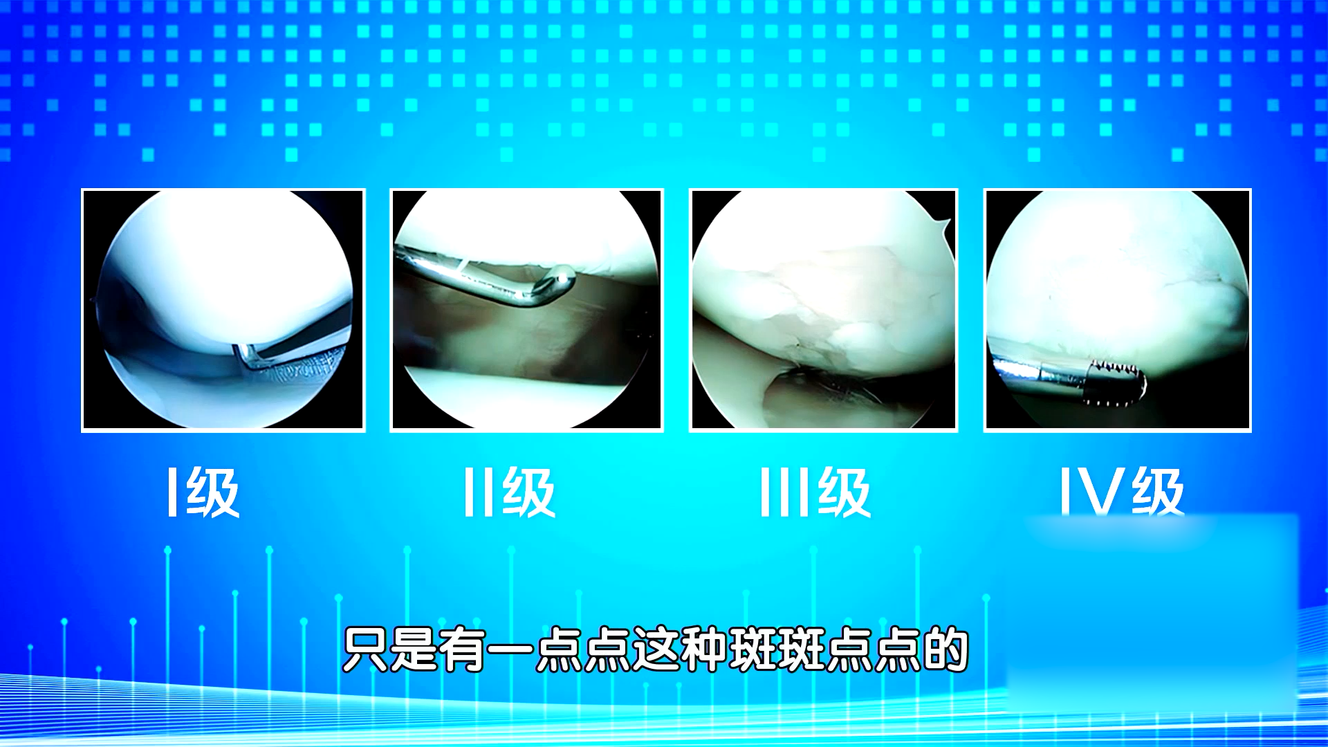 关节软骨损伤有这么几个分级_北京时间