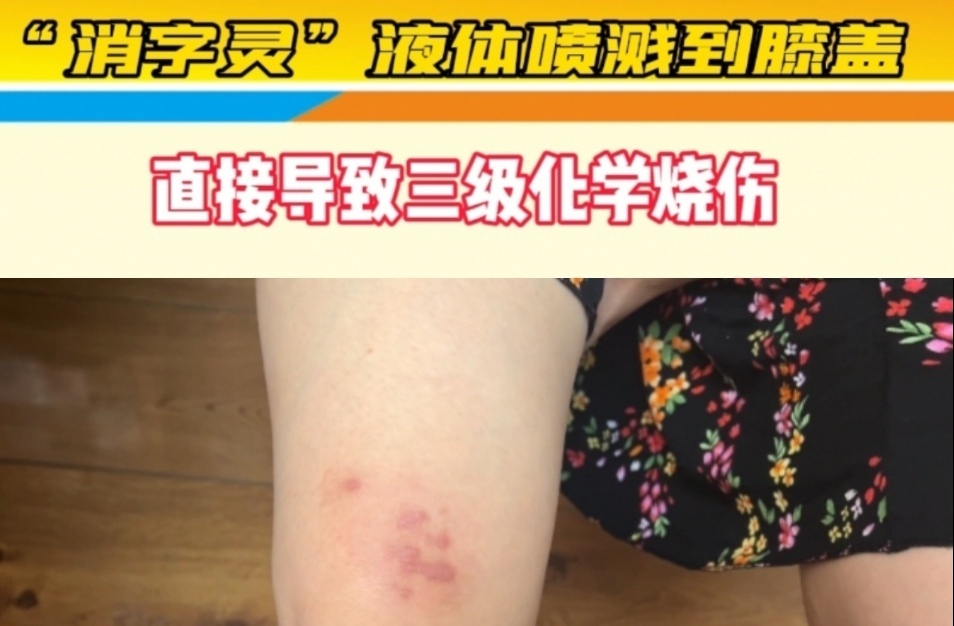 【主播说新闻】消字灵能造成烫伤！您知道吗？