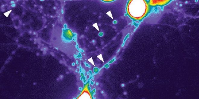 阿茨海默症或将终结 科学家有望将其消灭于萌芽 阿茨海默症或将终结 科学家有望将其消灭于萌芽