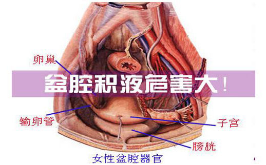 盆腔积液要不要紧,会不会影响怀孕?