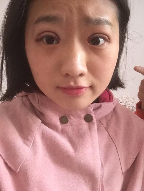 割了双眼皮眼睛大了好多,每天都会偷笑