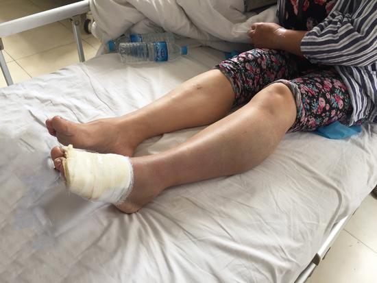 秦女士左脚被咬伤.