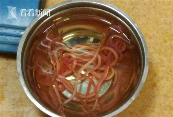 慎入！印度女子体内14条超大蛔虫 医生一条条取出