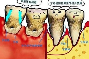 牙结石的原因与清除方法