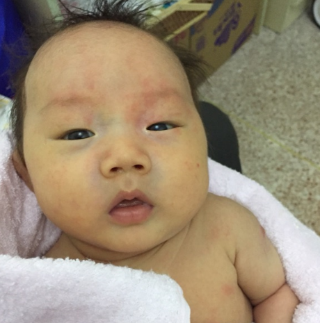 小儿长湿疹怎么办?掌握偏方不在干着急