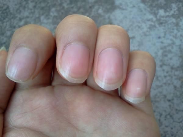 指甲上有竖纹,身体就是不健康的?医生:这2种才