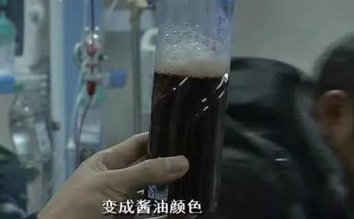 男童排出红褐色酱油尿 就因为吃了怪味豆 男童排出红褐色酱油尿 就因为吃了怪味豆