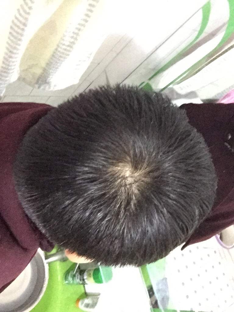 头皮里长疙瘩,不痛不痒是怎么回事?