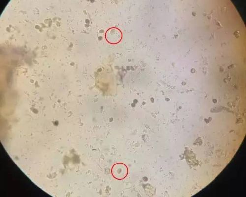 2岁男童尿片出现十几厘米蛔虫 爸妈急忙送