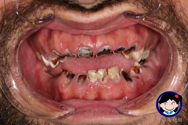 每天保持喝6六公升碳酸饮料陋习成瘾,忍受十年