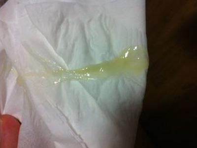 什么样的白带才算异常?白带异常的3个原因,第