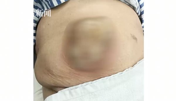 肚脐眼上长小包十几年成香瓜 大妈差点送了性