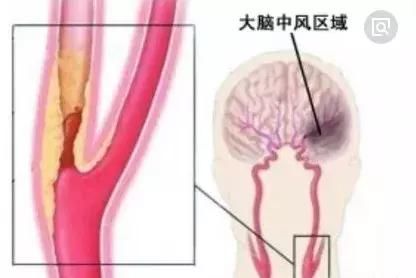 高血压伴颈动脉狭窄患者,血压降到多少合适?