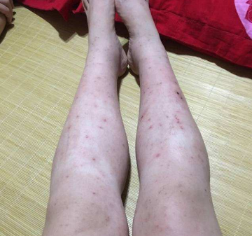 怀孕全身长湿疹怎么办?莫要心急乱用药