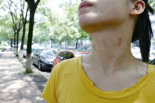 图为阿梅脖子被掐后留下的伤痕