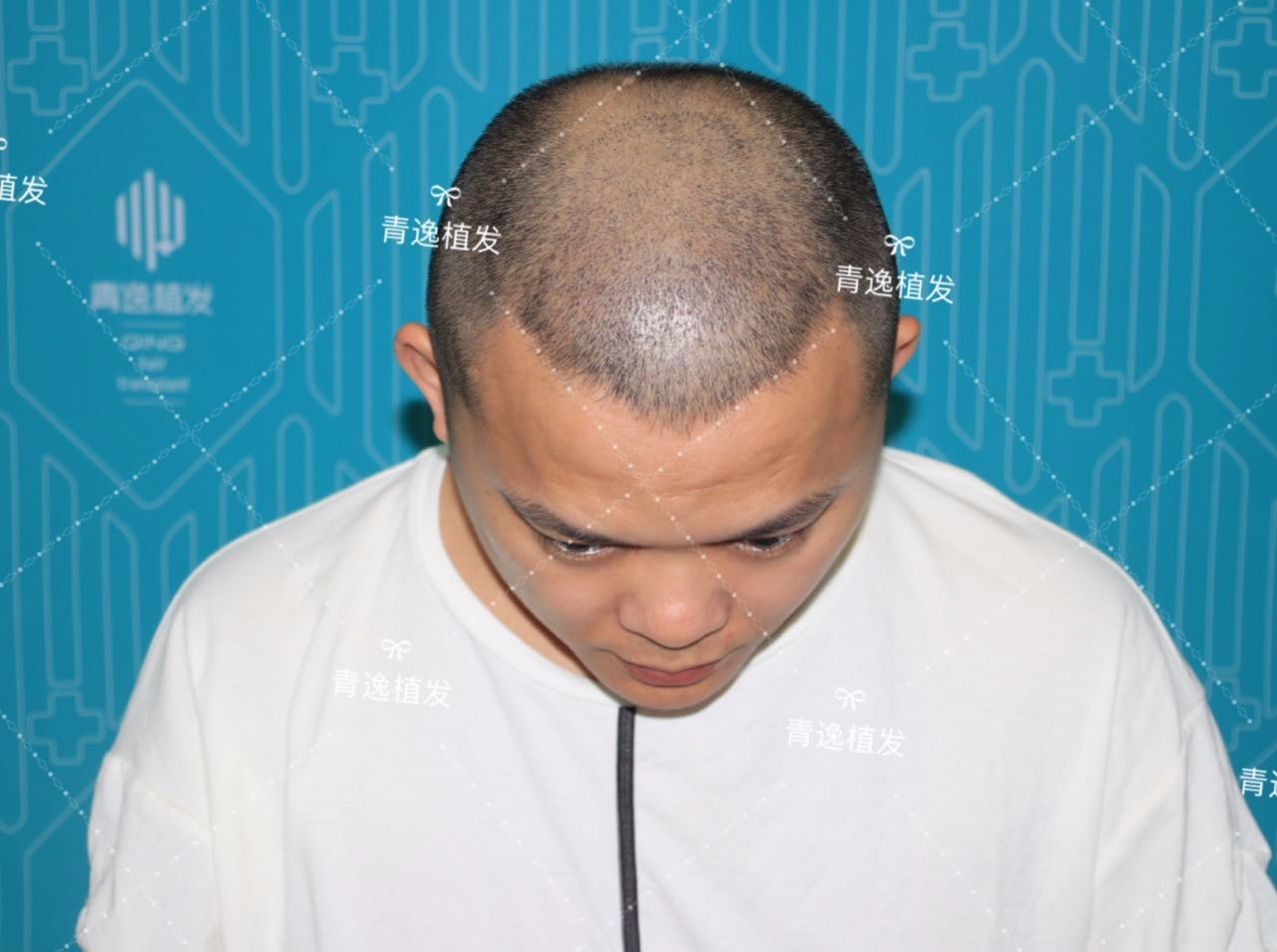 青逸植发种植头发之后效果能保持多久?