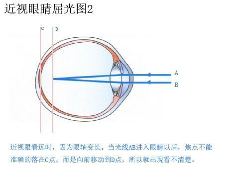 你的眼睛近视的过程中到底发生了哪些变化?