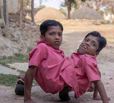 连体婴儿是先天畸形,印度连体兄弟至今没有分