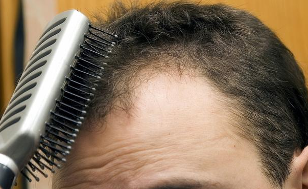 脱发的男人性能力更强?医生的回答让很多人笑了 脱发的男人性能力更强?医生的回答让很多人笑了