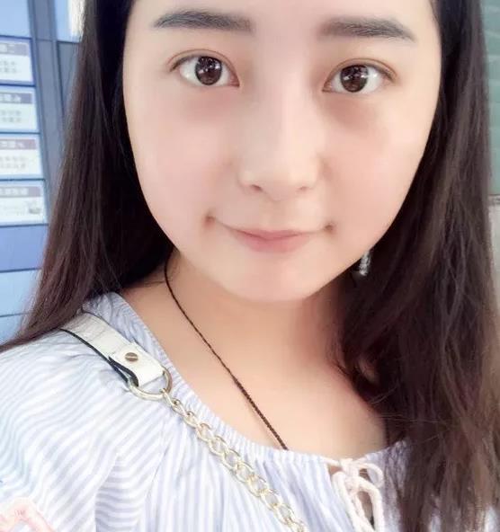 全切双眼皮后基本每天的变化都比较明显